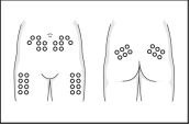 Medical diagram showing application sites for patches on the abdomen, hips, thighs, and buttocks of a stylized human body shown in front and back views