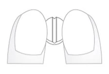 Diagramma schematico in bianco e nero che mostra la sezione trasversale di un corpo umano con i due lobi della tiroide e la trachea centrale