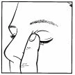 Black and white drawing showing a finger gently pressing the lower eyelid of a closed eye to administer a medication