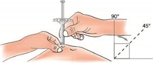 Medical illustration showing two hands applying a needle or injection device to the skin