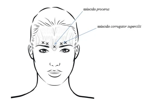 Disegno schematico di un volto femminile con indicazioni dei punti di iniezione per il muscolo procerus e il muscolo corrugatore supercilii