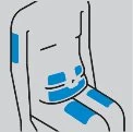 Diagramma schematico di un torso umano con aree blu che indicano i siti di iniezione sull'addome, sui fianchi e sulle cosce