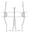 Stylized diagram of the human body indicating the thigh area with two gray regions and horizontal dashed lines for