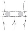 Diagramma schematico del bacino e delle cosce con due cerchi grigi posizionati sui fianchi delimitati da linee tratteggiate orizzontali