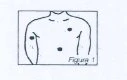Disegno schematico del busto di una persona con tre punti neri che indicano le zone di applicazione sul braccio, sul petto e sull'addome