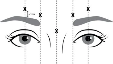 Diagramma medico di un volto con occhi e sopracciglia che mostra quattro punti di iniezione contrassegnati da X lungo linee tratteggiate verticali