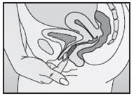 Anatomical diagram of the female pelvis showing the