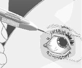 Medical illustration of a syringe with needle approaching the