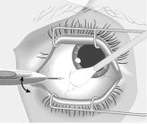 Medical drawing showing an open eye with metal eyelid speculums and a surgical instrument touching the ocular surface
