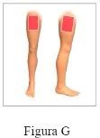 Diagramma di due gambe umane viste di profilo con aree rettangolari rosse applicate sulla parte superiore della coscia per indicare la zona di applicazione