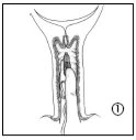 Disegno schematico in bianco e nero che mostra una sezione trasversale di un condotto anatomico con pareti interne striate e il numero uno cerchiato