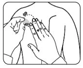 Disegno schematico di due mani che applicano un piccolo dispositivo medico sulla parte superiore della schiena di una persona