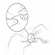 Disegno tecnico che mostra due mani che maneggiano un dispositivo medico con un ingrandimento circolare del dettaglio della parte superiore