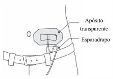 Schema medico che mostra un bendaggio con medicazione trasparente e nastro adesivo applicato sopra una cintura sulla vita di una persona