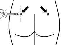 Diagramma medico che mostra una mano che impugna una siringa per un'iniezione nel gluteo con frecce che indicano i punti di inserzione