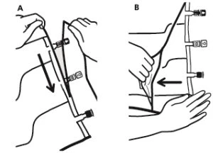 Two-part medical diagram showing hands manipulating a medical device with black arrows indicating the direction of movement