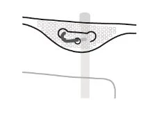 Medical diagram showing a ring-shaped device inserted into tissue with a pattern of small circles above a curved gray line