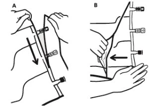 Diagramma medico in due parti che mostra le mani che manovrano un dispositivo medico con frecce nere che indicano la direzione del movimento