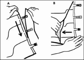 Diagramma medico in due fasi che mostra le mani che manovrano un dispositivo medico su una superficie cutanea con frecce direzionali
