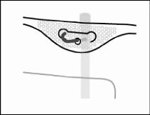 Diagramma medico che mostra un dispositivo medico inserito all'interno di un tessuto con una struttura a piccoli cerchi e una linea verticale grigia