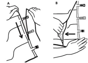 Two-part medical diagram showing hands manipulating a medical device with black arrows indicating the direction of movement