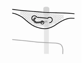 Schematic diagram showing a medical device inserted under the skin with a spiral structure and a gray vertical support