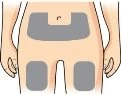 Diagramma del torso e delle gambe di una persona con tre aree grigie che indicano zone di applicazione sull'addome e sulle cosce