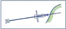 Diagramma tecnico che mostra l'inserimento di un ago sottile attraverso la pelle in un tessuto corporeo con una struttura a forma di arco