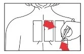 Schematic drawing of a human torso with three rectangles on the back and a hand applying a device with a directional red arrow