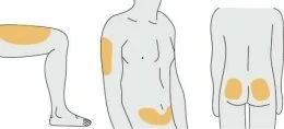 Tre diagrammi di un corpo umano che mostrano aree di applicazione colorate in giallo sulla coscia, sul braccio, sull'addome