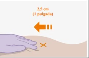 Illustrazione medica con freccia arancione che indica una distanza di 2,5 cm da una croce arancione posta su una superficie cutanea chiara