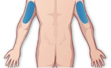Illustrazione medica del busto e delle braccia di una persona vista da dietro con due aree blu ovali posizionate sui muscoli deltoidi
