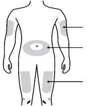 Human body diagram with gray areas highlighted on arms, abdomen and thighs, connected by black lines on the right and left sides