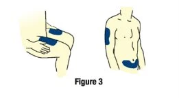 Disegni schematici di un corpo umano che indicano i siti di applicazione del farmaco sulla coscia e sul tronco con aree blu evidenziate