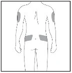 Disegno schematico del corpo umano visto di schiena con aree grigioni evidenziate sulle braccia e sui fianchi per indicare i siti di applicazione