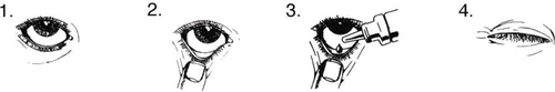Sequenza di quattro disegni che mostrano come applicare gocce oculari: l'occhio aperto, la mano che sostiene la palpebra e il contagio della goccia nell'occhio