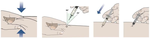 Sequenza di quattro illustrazioni che mostrano come preparare la pelle e iniettare il farmaco con un ago a 90 o 45 gradi con una siringa