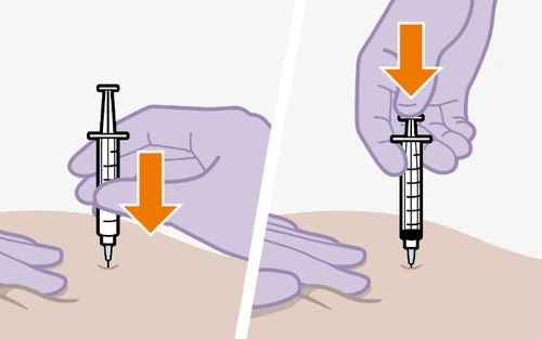 Medical illustration showing two phases of an injection procedure