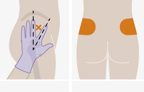 Medical diagram showing a gloved hand indicating the correct injection site on a body area