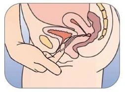 Diagrama médico que muestra una mano que inserta un dispositivo en forma de anillo en la