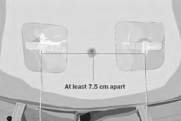 Medical diagram showing two circles applied on the abdominal area, spaced at least 7.5 centimeters apart