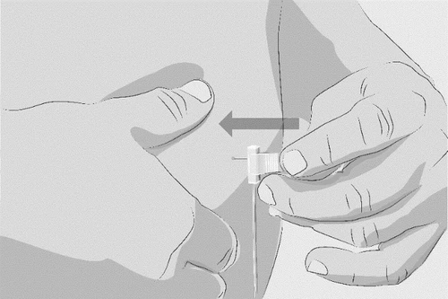 Two hands manipulating a subcutaneous medical device on an abdomen, with an arrow indicating the insertion movement toward the skin