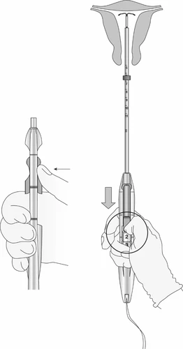 Disegno tecnico che mostra due mani che impugnano un dispositivo medico a forma di siringa con frecce che indicano il movimento di pressione