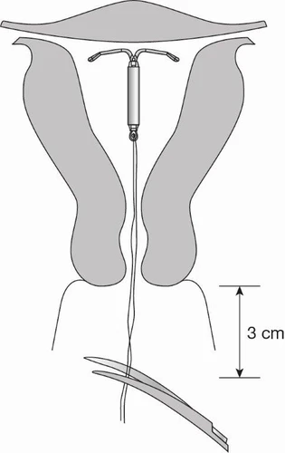 Diagramma medico che mostra un dispositivo intrauterino inserito nell'utero con una linea di riferimento di 3 cm verso la cervice