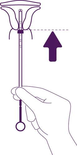 Illustrazione medica che mostra una mano che solleva un dispositivo a stantuffo verso l'alto all'interno di un contenitore con scala graduata