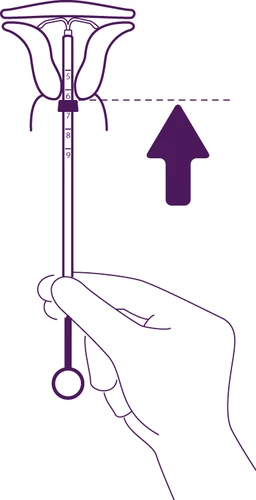 Diagramma medico che mostra una mano che spinge verso l'alto un dispositivo intrauterino all'interno dell'utero con una freccia rivolta verso l'alto