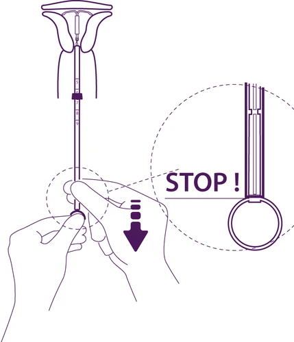 Disegno tecnico viola che mostra mani che impugnano un dispositivo medico con una freccia verso il basso e un ingrandimento con la scritta STOP