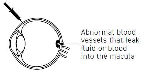 Diagram of an eye with a syringe injecting a drug and an arrow indicating abnormal blood vessels in the macula