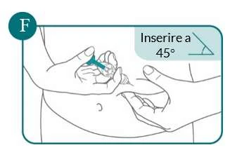 Diagram showing two hands inserting a needle into the abdomen of the