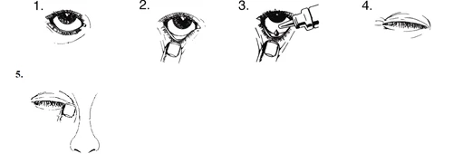 Sequenza di cinque disegni che mostrano l'applicazione di un collirio con un applicatore su un occhio aperto e poi chiuso vicino al naso